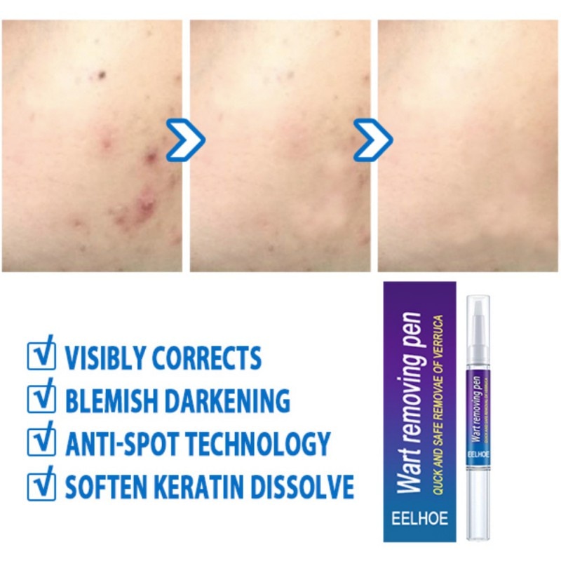 Wart Removal Mole Remedy Liquid Pen Treatment Papillomas Removing Skin Labels Flat Wart Genitals Painless Beauty Herbal Cream