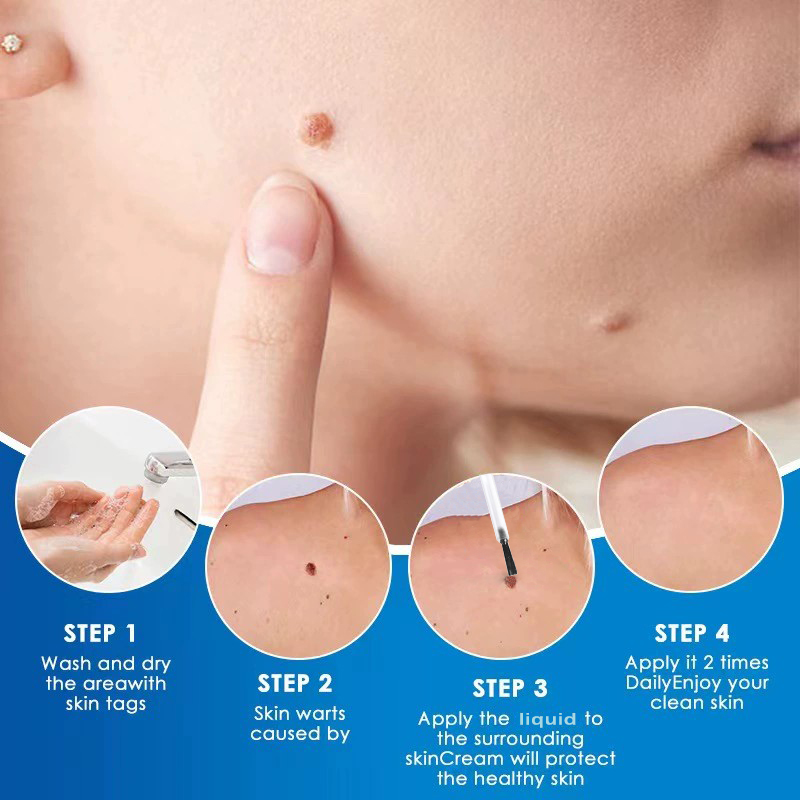 Skin Tags Remover Painless Mole Skin Dark Spot Warts Remover Tag Treatment